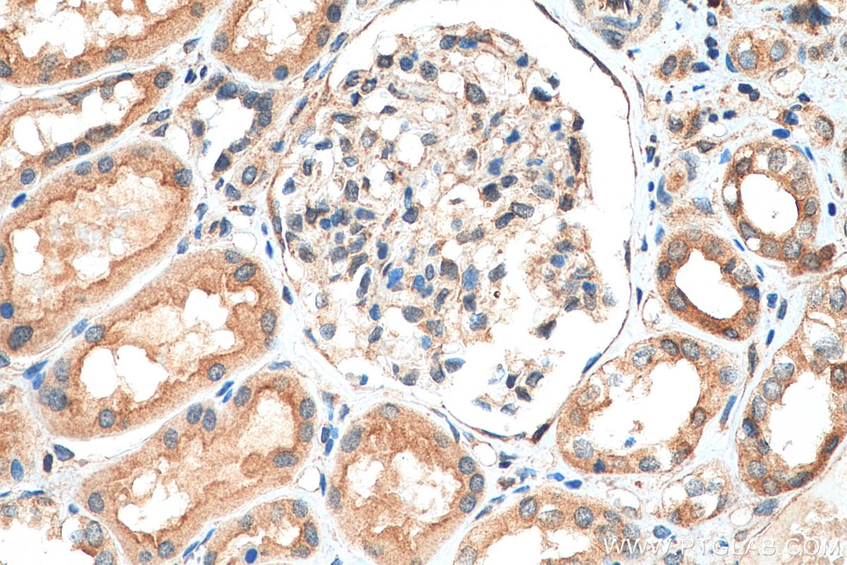 Immunohistochemistry (IHC) staining of human renal cell carcinoma tissue using FXYD4 Polyclonal antibody (11966-1-AP)