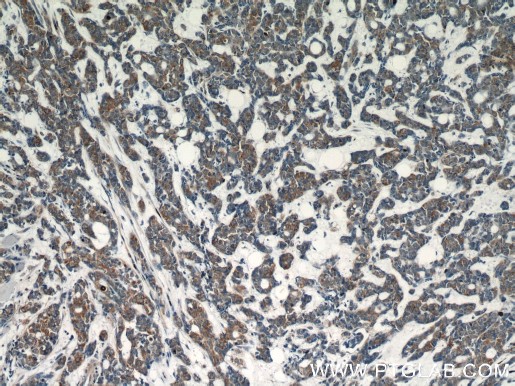 Immunohistochemistry (IHC) staining of human cervical cancer tissue using Dysadherin Polyclonal antibody (12166-1-AP)