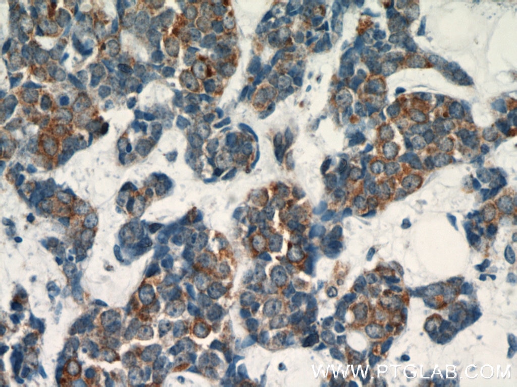 Immunohistochemistry (IHC) staining of human cervical cancer tissue using Dysadherin Polyclonal antibody (12166-1-AP)