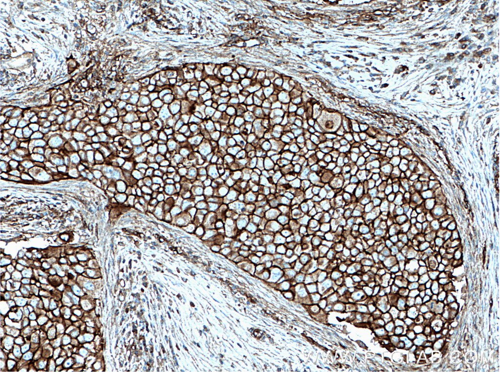 Immunohistochemistry (IHC) staining of human breast cancer tissue using FYN Monoclonal antibody (66606-1-Ig)