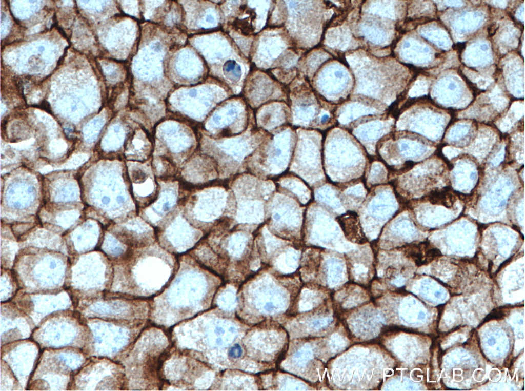 Immunohistochemistry (IHC) staining of human breast cancer tissue using FYN Monoclonal antibody (66606-1-Ig)