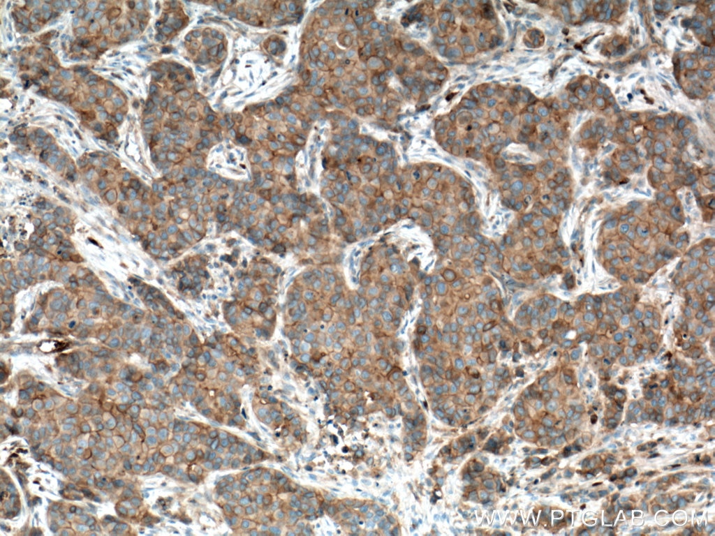 Immunohistochemistry (IHC) staining of human breast cancer tissue using FYN Monoclonal antibody (66606-1-Ig)