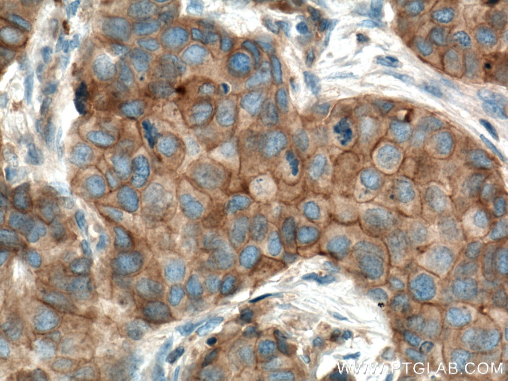 Immunohistochemistry (IHC) staining of human breast cancer tissue using FYN Monoclonal antibody (66606-1-Ig)