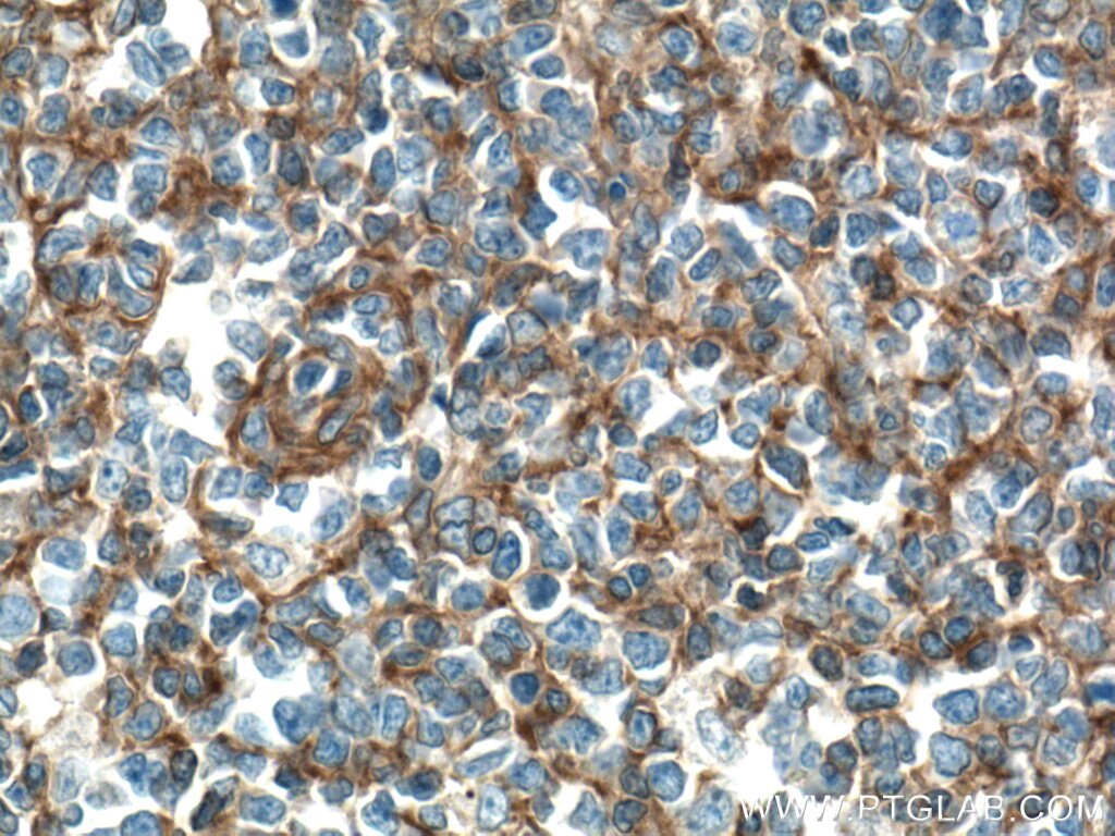 Immunohistochemistry (IHC) staining of human tonsillitis tissue using FYN Monoclonal antibody (66606-1-Ig)