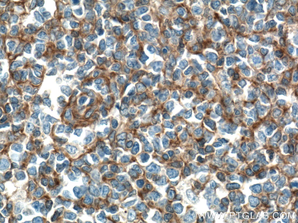 IHC staining of human tonsillitis using 66606-1-Ig