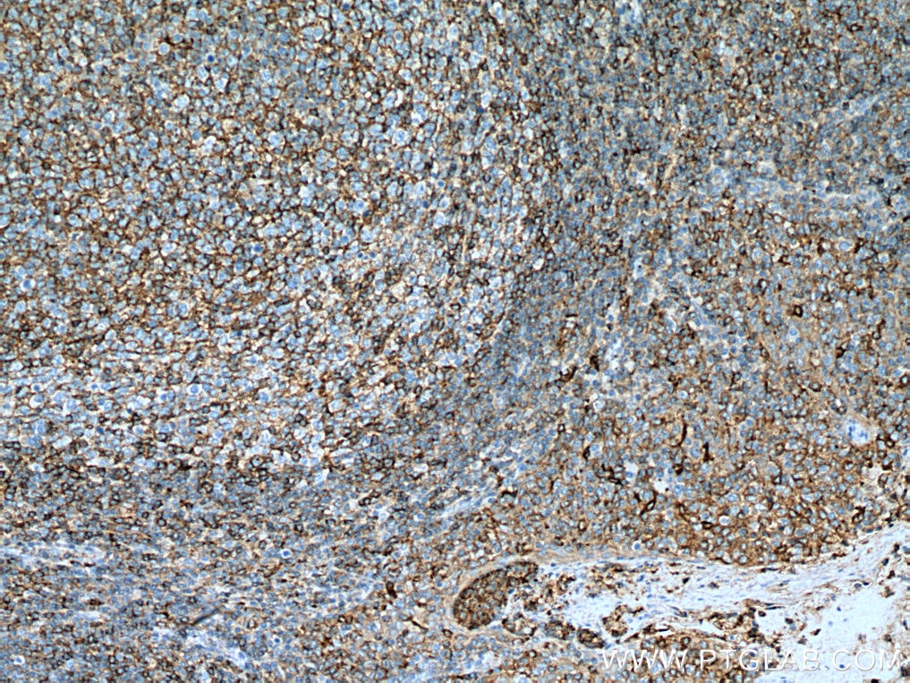 Immunohistochemistry (IHC) staining of human tonsillitis tissue using FYN Monoclonal antibody (66606-1-Ig)