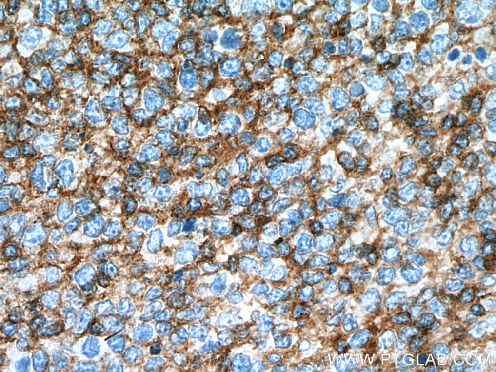 Immunohistochemistry (IHC) staining of human tonsillitis tissue using FYN Monoclonal antibody (66606-1-Ig)