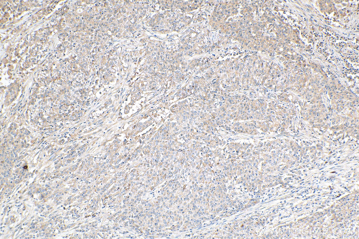 Immunohistochemistry (IHC) staining of human stomach cancer tissue using Frizzled 5 Polyclonal antibody (21519-1-AP)