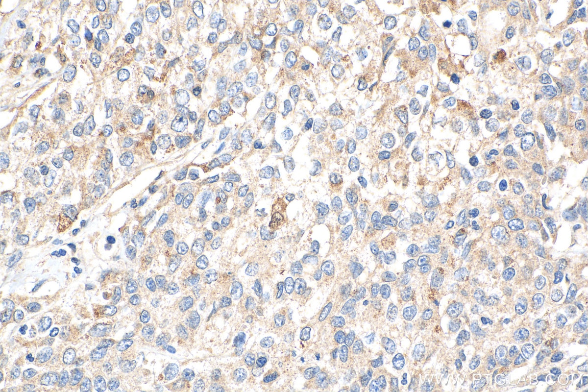 IHC staining of human stomach cancer using 21519-1-AP