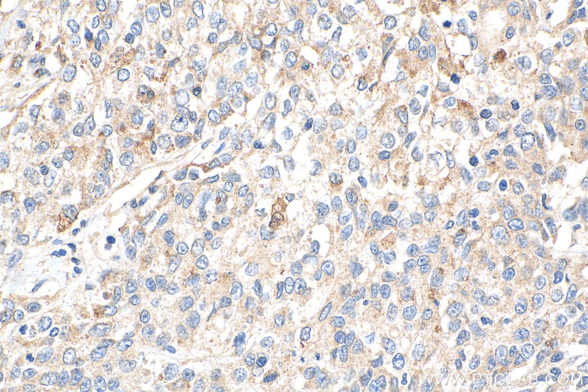 Immunohistochemistry (IHC) staining of human stomach cancer tissue using Frizzled 5 Polyclonal antibody (21519-1-AP)