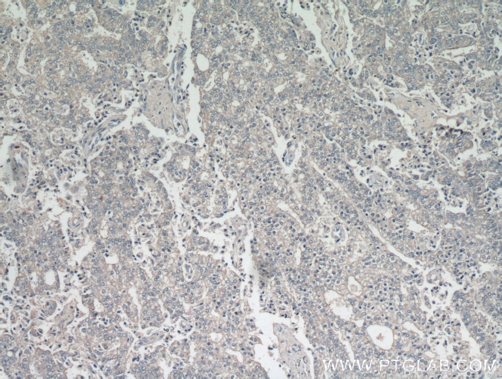 IHC staining of human prostate cancer using 21519-1-AP