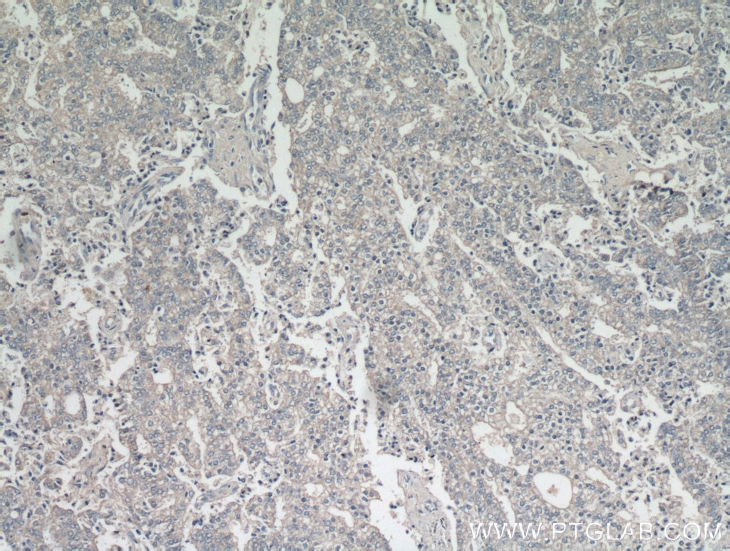 Immunohistochemistry (IHC) staining of human prostate cancer tissue using Frizzled 5 Polyclonal antibody (21519-1-AP)