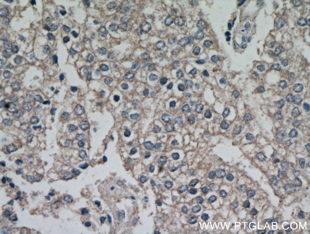 Immunohistochemistry (IHC) staining of human prostate cancer tissue using Frizzled 5 Polyclonal antibody (21519-1-AP)