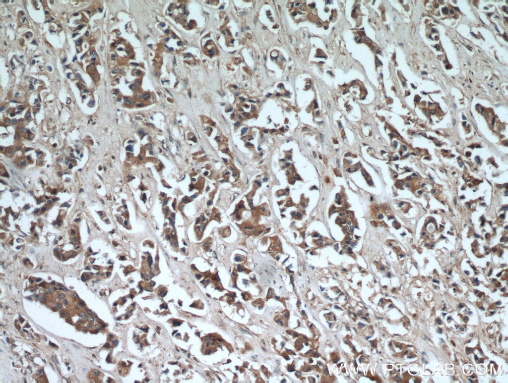 Immunohistochemistry (IHC) staining of human breast cancer tissue using FZD6 Polyclonal antibody (13982-1-AP)