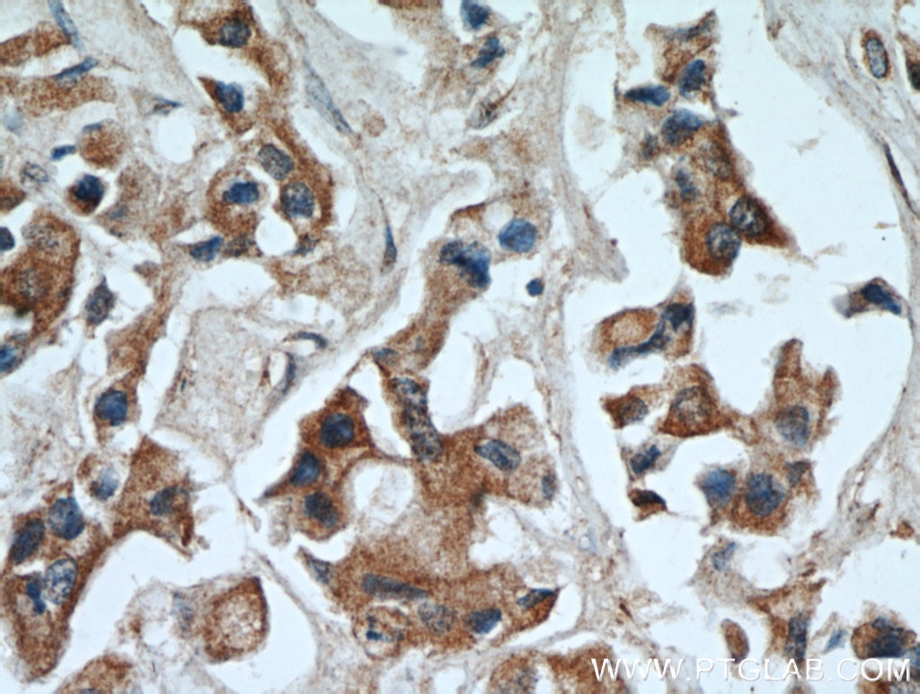 Immunohistochemistry (IHC) staining of human breast cancer tissue using FZD6 Polyclonal antibody (13982-1-AP)
