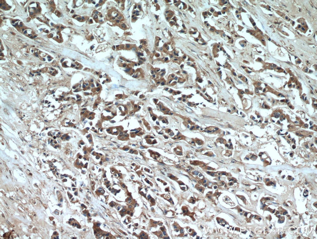 Immunohistochemistry (IHC) staining of human breast cancer tissue using FZD6 Polyclonal antibody (13982-1-AP)