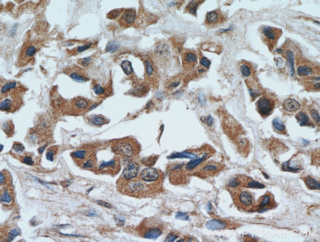 Immunohistochemistry (IHC) staining of human breast cancer tissue using FZD6 Polyclonal antibody (13982-1-AP)