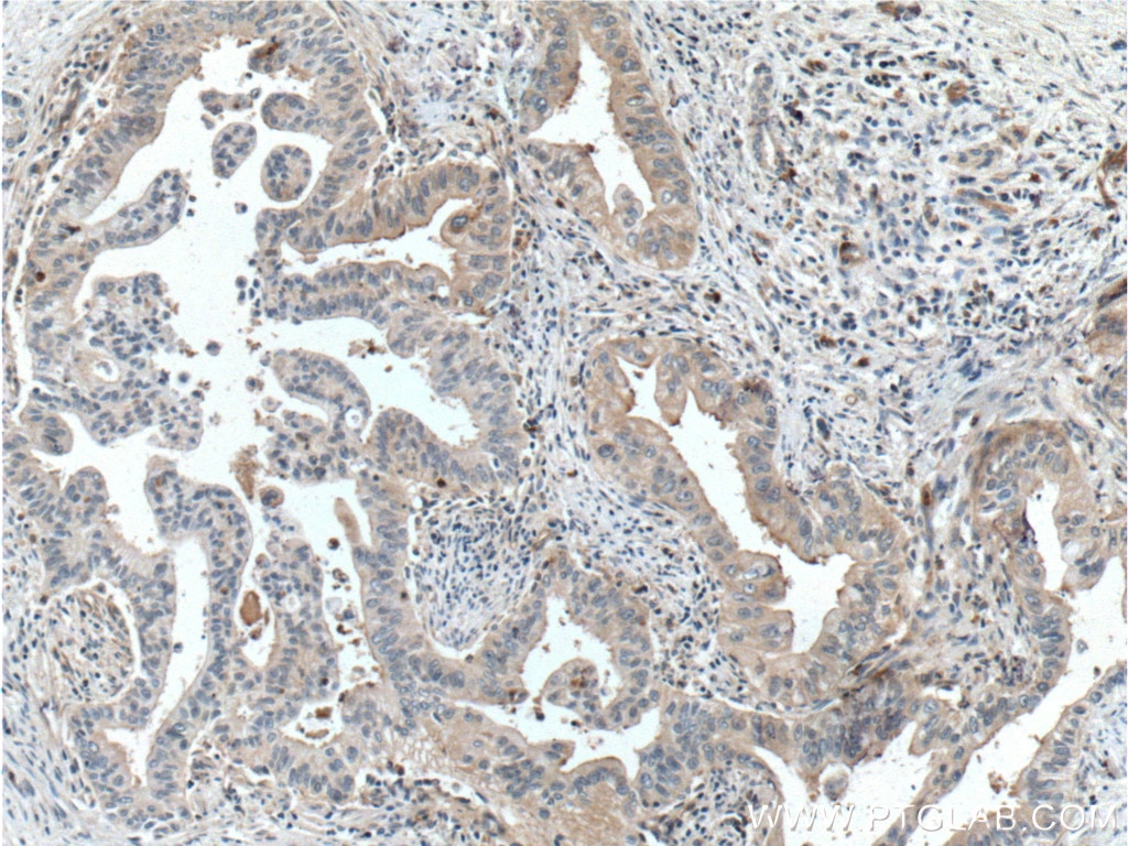 Immunohistochemistry (IHC) staining of human pancreas cancer tissue using Frizzled 8 Polyclonal antibody (55093-1-AP)