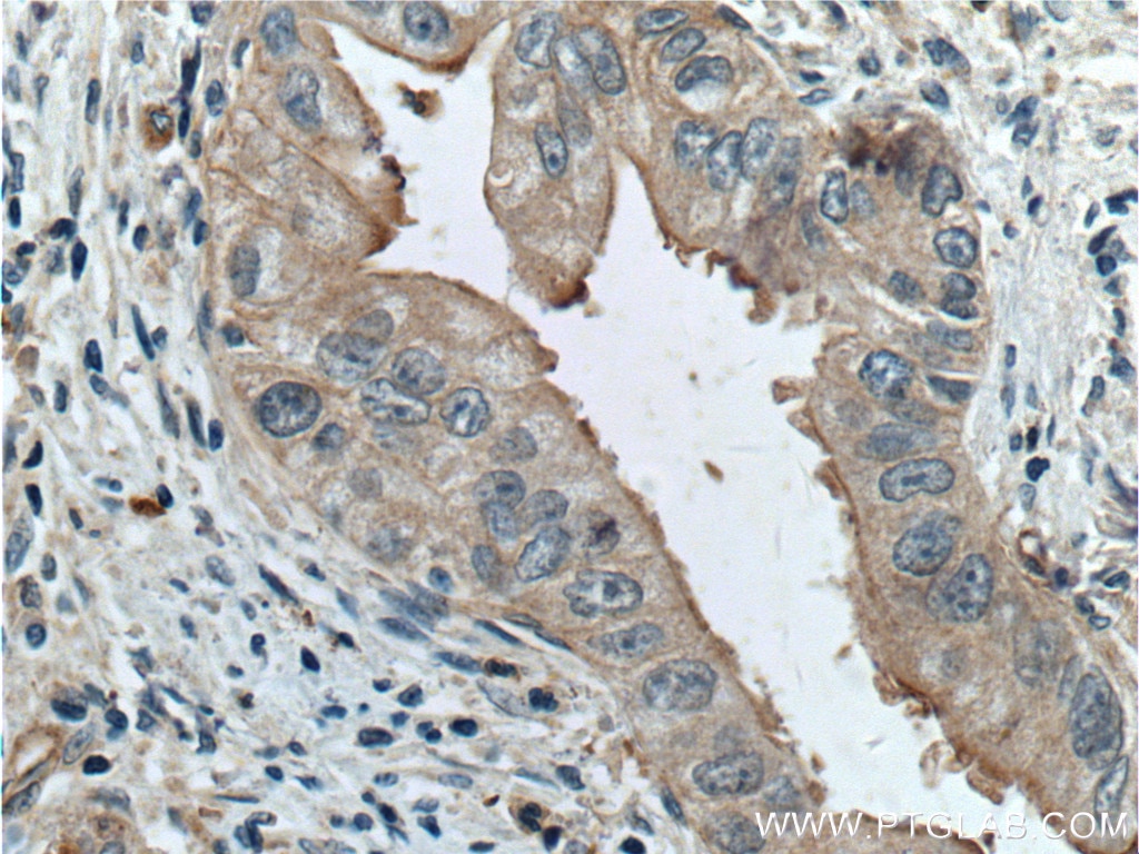 Immunohistochemistry (IHC) staining of human pancreas cancer tissue using Frizzled 8 Polyclonal antibody (55093-1-AP)