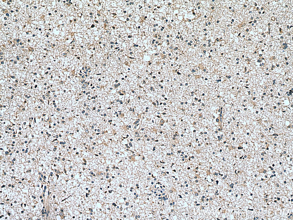 Immunohistochemistry (IHC) staining of human gliomas tissue using Frizzled 9 Polyclonal antibody (13865-1-AP)