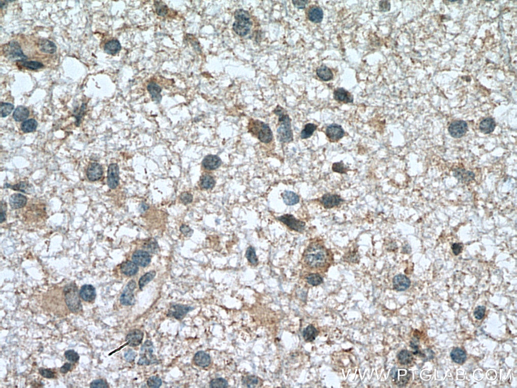 Immunohistochemistry (IHC) staining of human gliomas tissue using Frizzled 9 Polyclonal antibody (13865-1-AP)