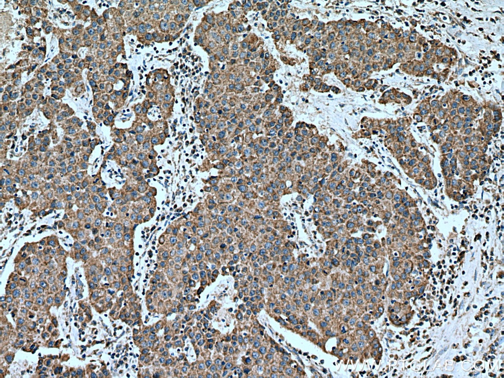 Immunohistochemistry (IHC) staining of human breast cancer tissue using FZR1/Cdh1 Polyclonal antibody (16368-1-AP)