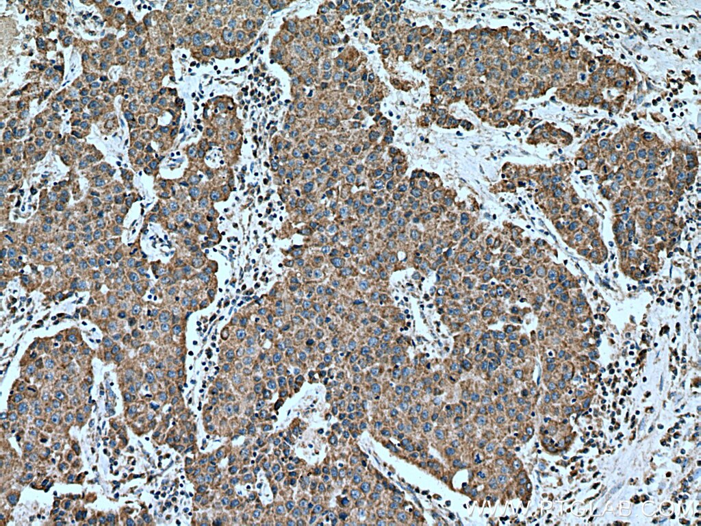 IHC staining of human breast cancer using 16368-1-AP