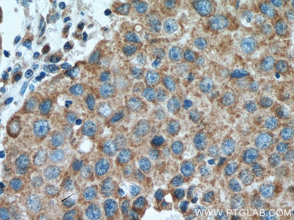 Immunohistochemistry (IHC) staining of human breast cancer tissue using FZR1/Cdh1 Polyclonal antibody (16368-1-AP)