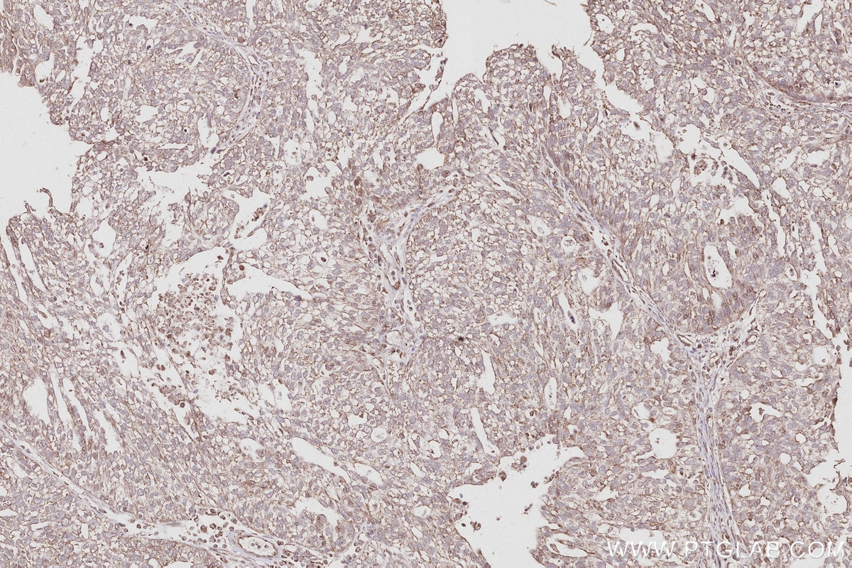IHC staining of human ovary cancer using 16368-1-AP Immunohistochemistry (IHC) staining of human ovary cancer tissue using FZR1/Cdh1 Polyclonal antibody (16368-1-AP)