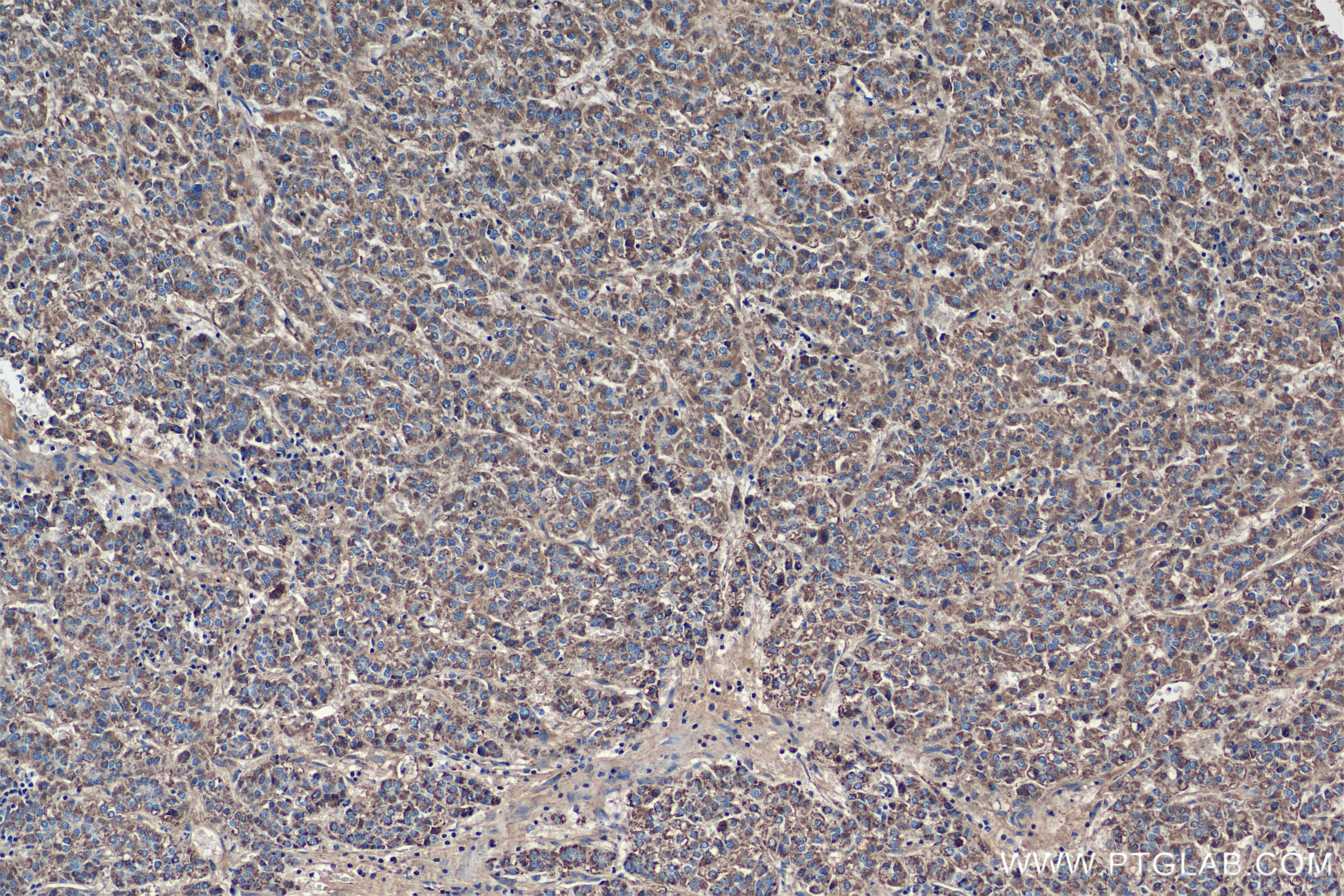 Immunohistochemistry (IHC) staining of Human Hepatocellular cancer using Factor IX/PTC Recombinant antibody (84533-4-RR)