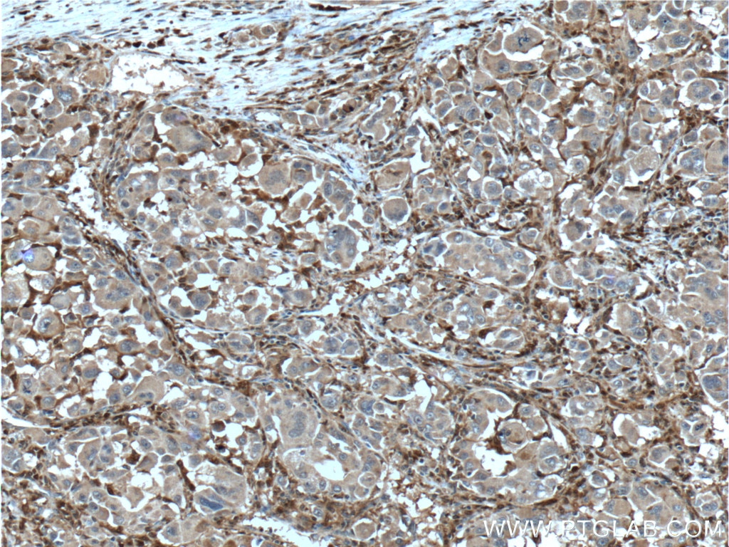 Immunohistochemistry (IHC) staining of human liver cancer tissue using Factor XIIIa Monoclonal antibody (66325-1-Ig)