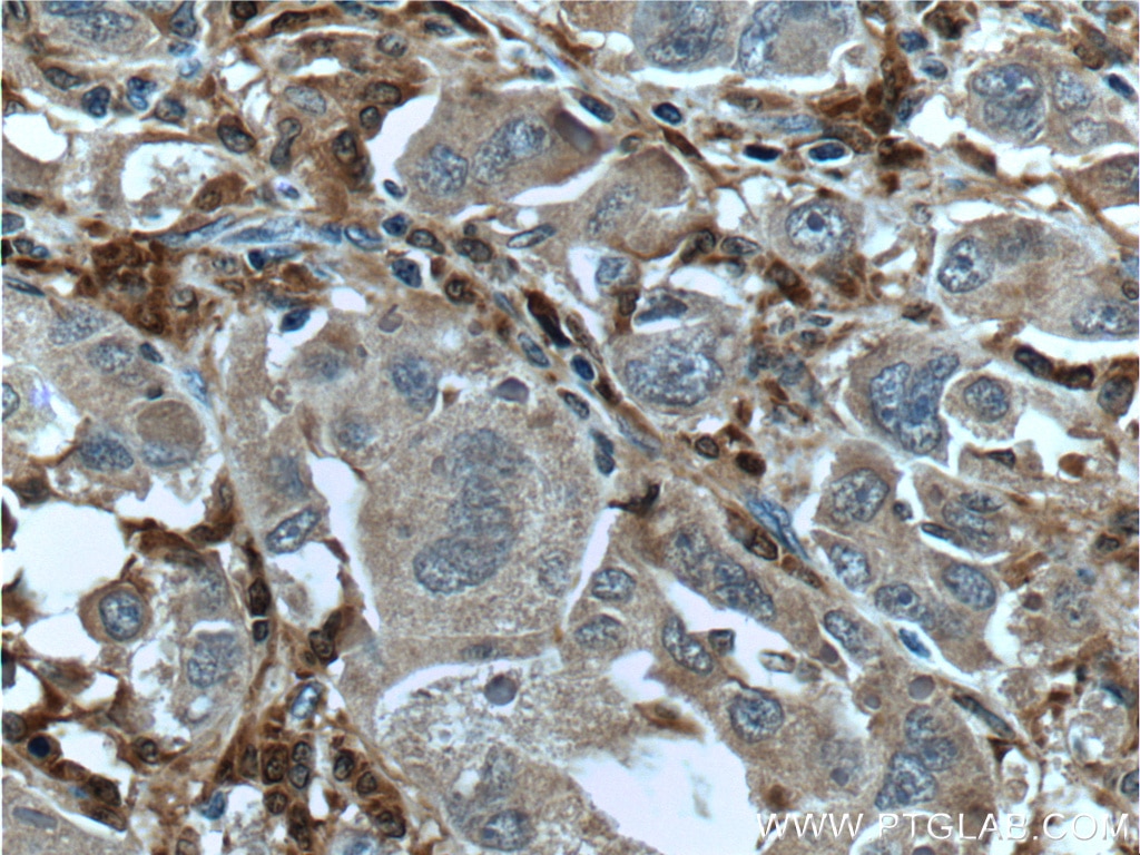 Immunohistochemistry (IHC) staining of human liver cancer tissue using Factor XIIIa Monoclonal antibody (66325-1-Ig)