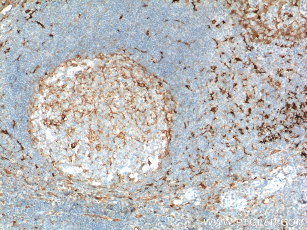 Immunohistochemistry (IHC) staining of human tonsillitis tissue using Fascin Monoclonal antibody (66321-1-Ig)