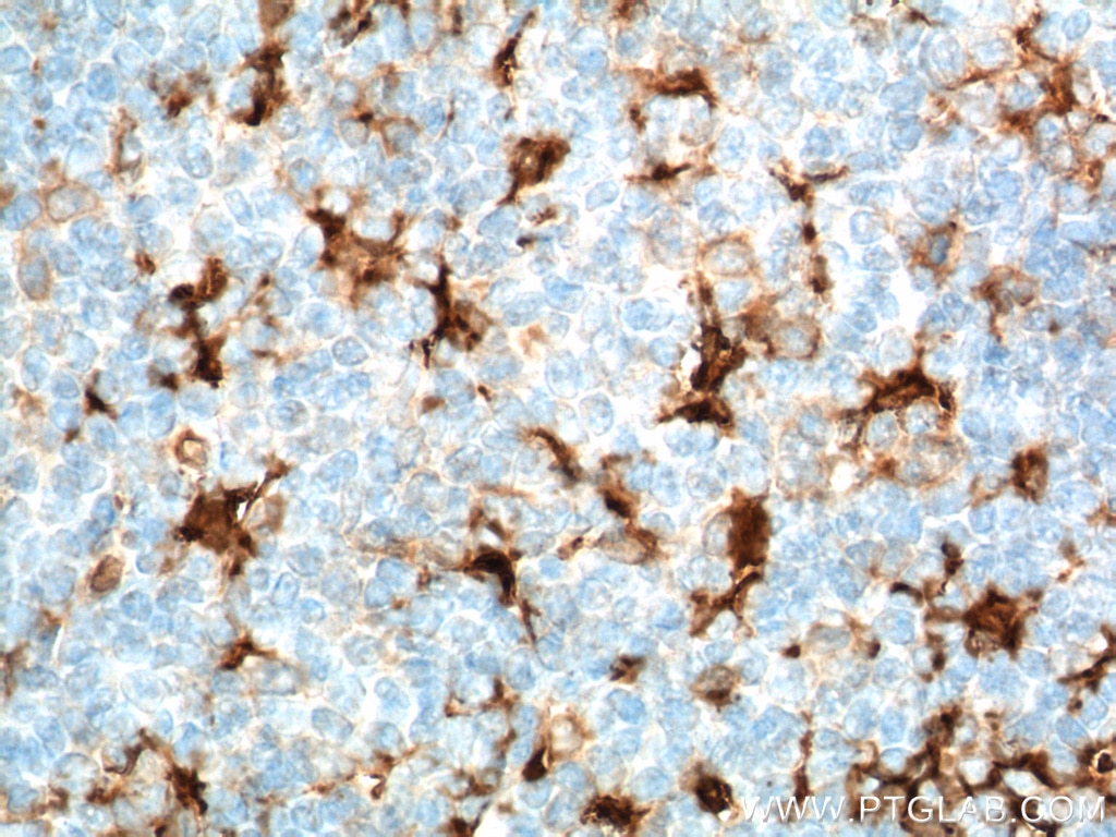 Immunohistochemistry (IHC) staining of human tonsillitis tissue using Fascin Monoclonal antibody (66321-1-Ig)