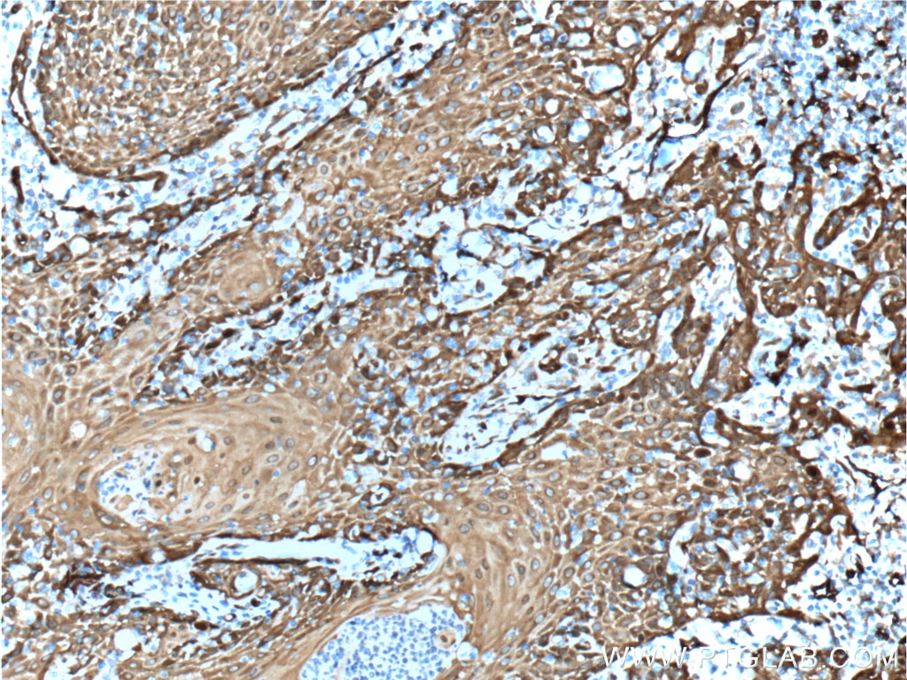 Immunohistochemistry (IHC) staining of human skin cancer tissue using Fascin Monoclonal antibody (66321-1-Ig)