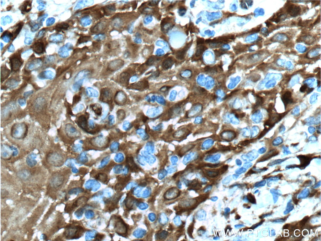 Immunohistochemistry (IHC) staining of human skin cancer tissue using Fascin Monoclonal antibody (66321-1-Ig)