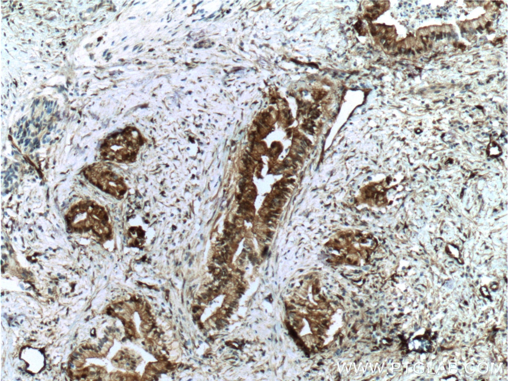 IHC staining of human pancreas cancer using 66321-1-Ig