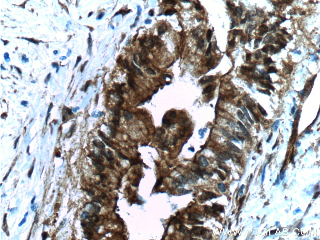 Immunohistochemistry (IHC) staining of human pancreas cancer tissue using Fascin Monoclonal antibody (66321-1-Ig)