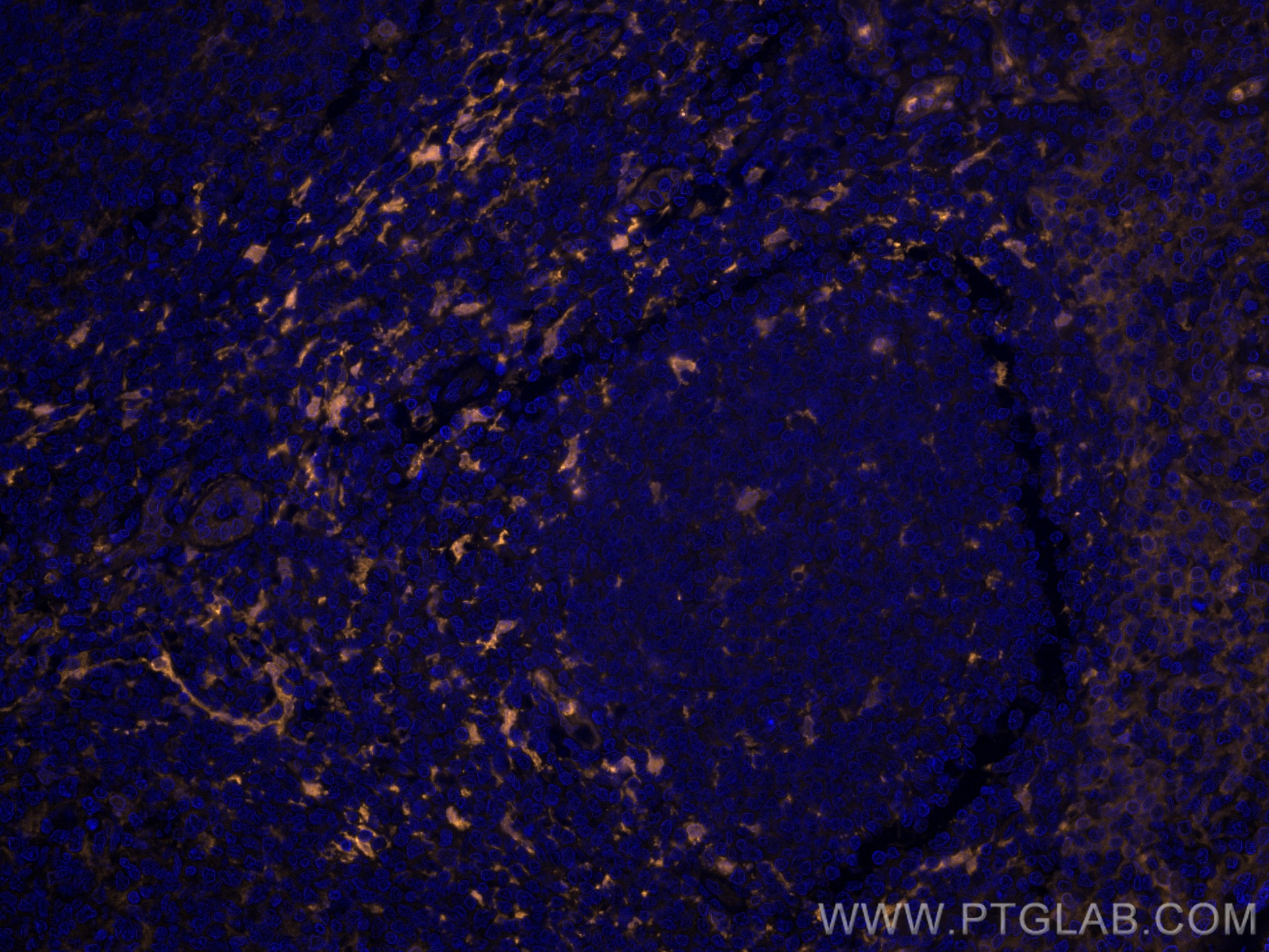 Immunofluorescence (IF) / fluorescent staining of human tonsillitis tissue using CoraLite®555-conjugated Fascin Monoclonal antibody (CL555-66321)