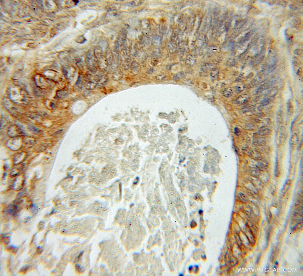 Immunohistochemistry (IHC) staining of human ovary tumor tissue using Fhl1 Polyclonal antibody (51015-1-AP)
