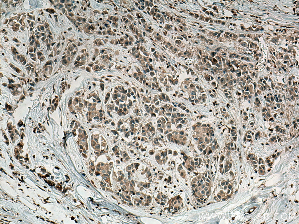 Immunohistochemistry (IHC) staining of human breast cancer tissue using Fibrillin 1  Polyclonal antibody (26935-1-AP)