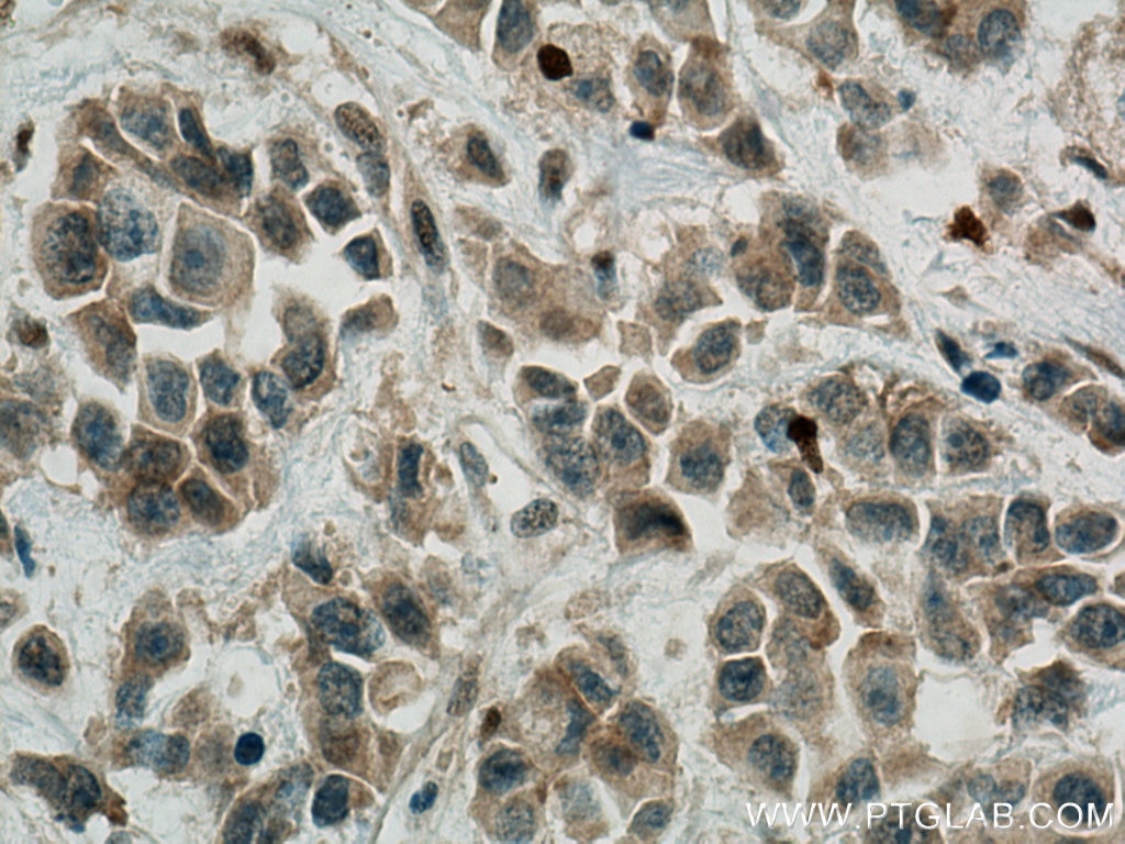 Immunohistochemistry (IHC) staining of human breast cancer tissue using Fibrillin 1  Polyclonal antibody (26935-1-AP)