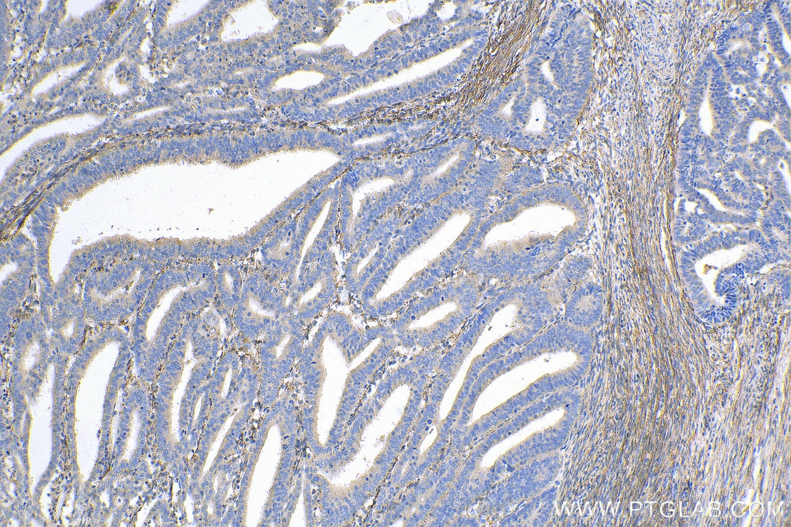 Immunohistochemistry (IHC) staining of human endometrial cancer tissue using Fibrillin 1 Polyclonal antibody (29425-1-AP)