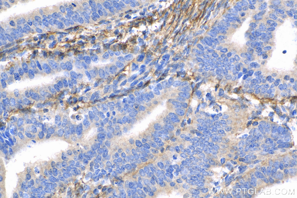 Immunohistochemistry (IHC) staining of human endometrial cancer tissue using Fibrillin 1 Polyclonal antibody (29425-1-AP)