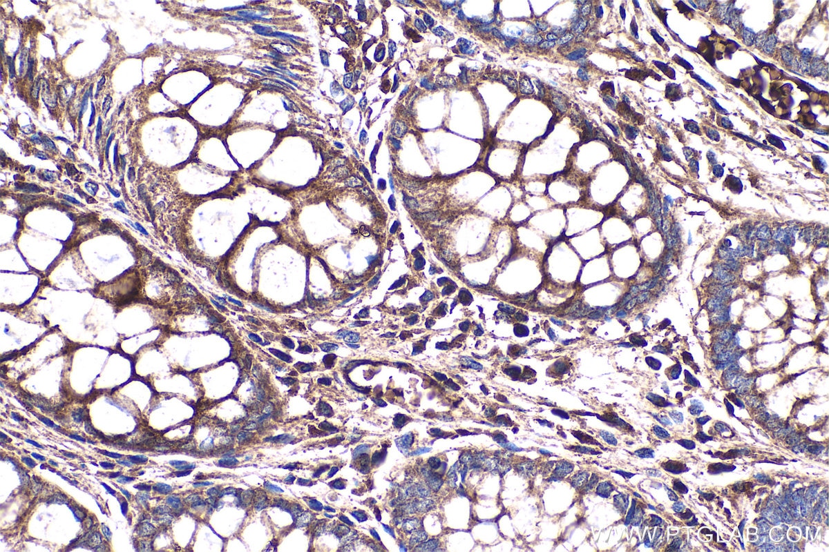 Immunohistochemistry (IHC) staining of human colon tissue using Fibrinogen Alpha Chain Polyclonal antibody (20645-1-AP)