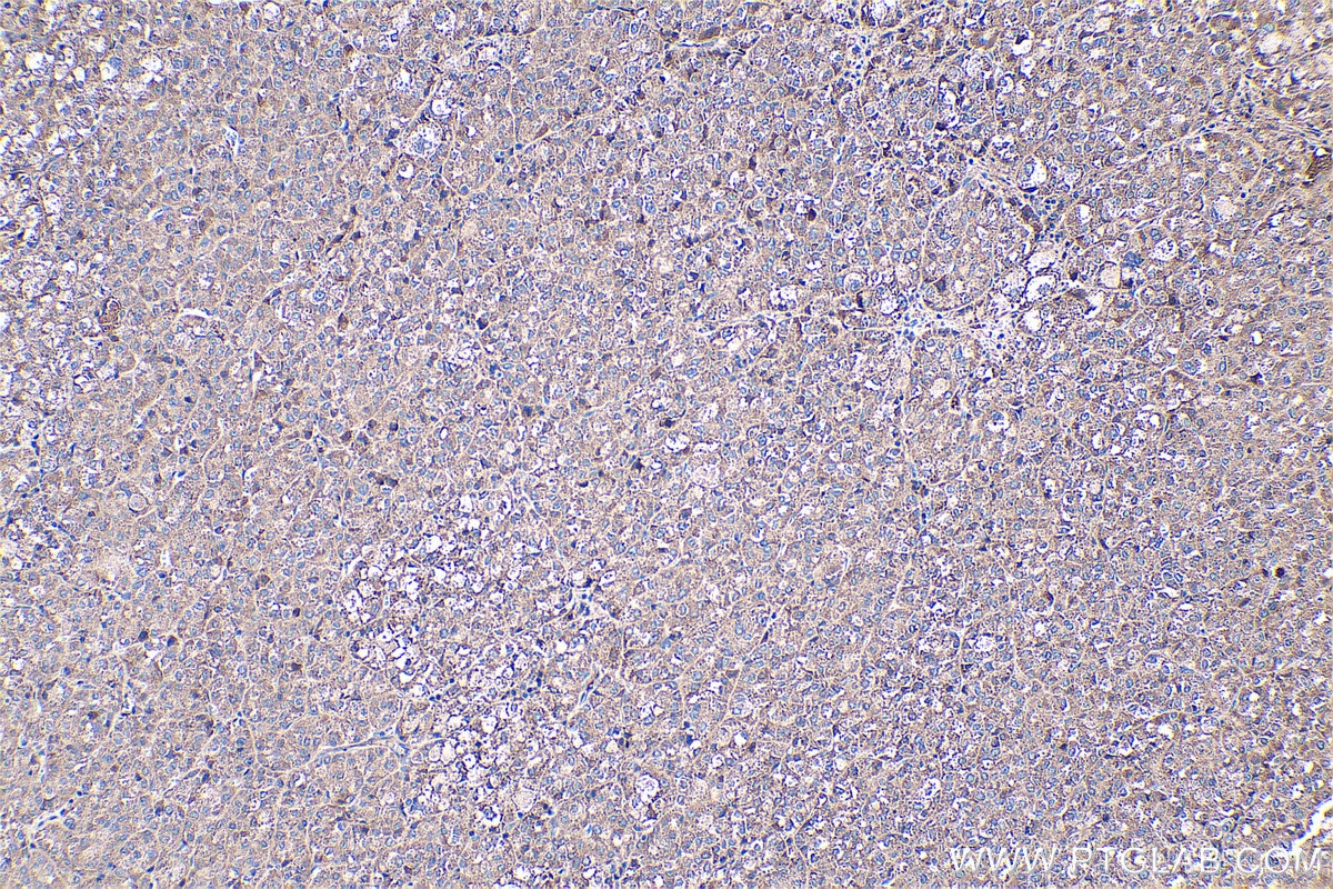 IHC staining of human liver cancer using 20645-1-AP