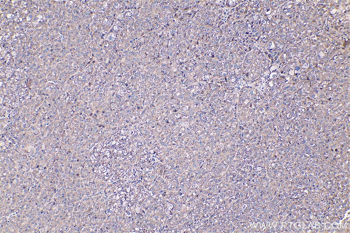 Immunohistochemistry (IHC) staining of human liver cancer tissue using Fibrinogen Alpha Chain Polyclonal antibody (20645-1-AP)