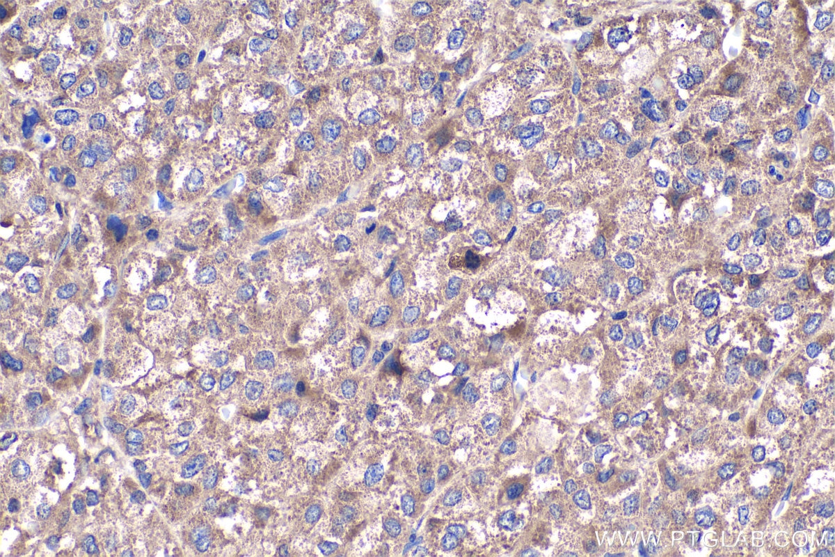 Immunohistochemistry (IHC) staining of human liver cancer tissue using Fibrinogen Alpha Chain Polyclonal antibody (20645-1-AP)