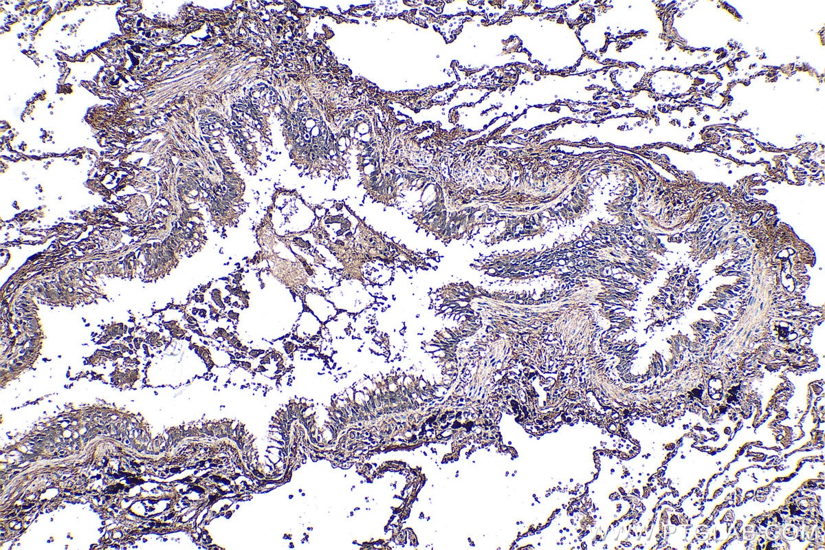 Immunohistochemistry (IHC) staining of human lung cancer tissue using Fibrinogen Alpha Chain Polyclonal antibody (20645-1-AP)