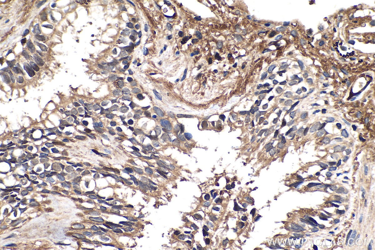 Immunohistochemistry (IHC) staining of human lung cancer tissue using Fibrinogen Alpha Chain Polyclonal antibody (20645-1-AP)